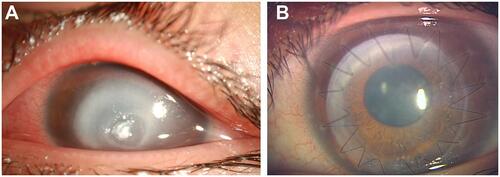 Figure 2 Preoperative and postoperative appearance of typical case (Case 3). A 18-year-old woman with Paecilomyces keratitis was treated with antifungal agents for 1 month without resolution (A). Two months after surgery, a clear cornea was regained with corrected visual acuity of −0.2 logarithm of minimal angle of resolution unit in her left eye (B).