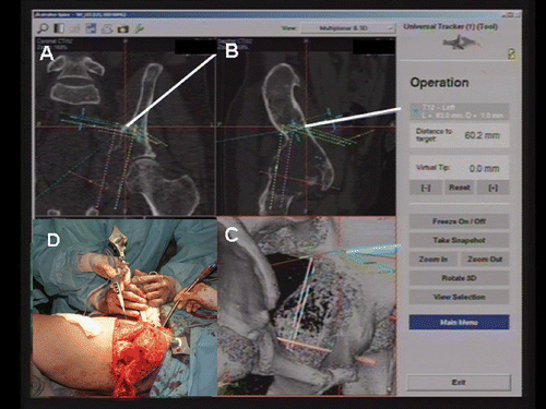 Figure 5. Intraoperative screen images on the navigation monitor. The location of the navigated diathermy electrode (white line) was seen in relation to the peri-acetabular tumor. The proximal margin and location of planned screws could be identified in coronal images (A), obliques images (B), and reconstructed three-dimensional images (C). In panel D, a dynamic reference base tracker is seen attached to the left iliac crest, with a navigated diathermy electrode being used to identify the virtual margin and the resection level on the navigation monitor. [Color version available online.]