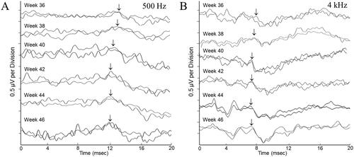 Figure 1. Auditory brainstem response waveforms were obtained over the 10-week data collection period for a female participant born at 32 weeks gestation. There are two tracings for every timepoint, each reflecting the averaged waveform from 2000 post-stimulus EEG samples. Waveform morphology and latencies are representative of those seen for the “pre-term” participant group showing improved response definition and decreased response latency throughout the study. Responses were obtained to 500 Hz tone bursts (panel A) and 4000 Hz tone bursts (panel B) presented to the test ear at 70 dBnHL. The arrow markers represent the Wave V peak in the response complex.