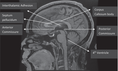 Figure 1. Mid-sagittal brain MRI showing the corpus callosum.