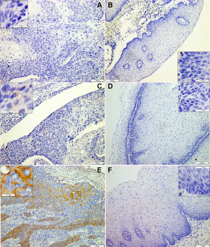 Figure 2 Immunohistochemical staining of PABPC1 in ESCC.