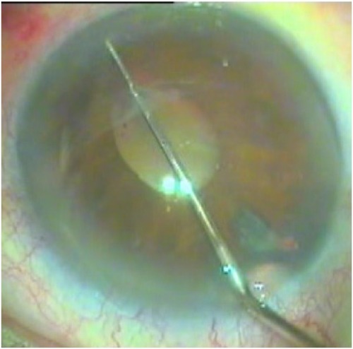 Figure 2 Small iris sphincter ruptures.