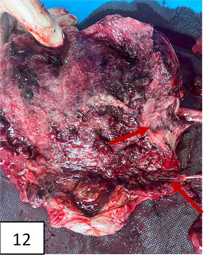 Figure 12. The uterus after hysterectomy with the placenta in situ (pathohistological specimen): thinning of the lower uterine segment and placental tissue, invading the myometrium.