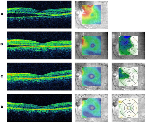 Figure 2 Optical coherence tomography studies over the macula on the day of treatment with half-fluence PDT and aflibercept (A), three weeks post-treatment (B), five weeks post-treatment (C), and eight weeks post-treatment (D). Columns left to right: horizontal OCT cuts over the fovea, contour map of the central macula, and difference map of macular thickness (microns) between each sequential scan.