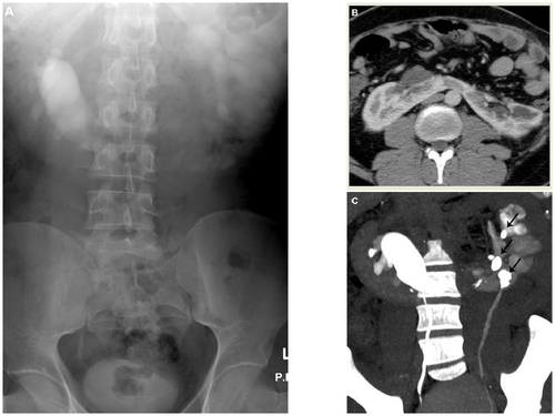 Figure 2 Horse shoe kidney. (A) Intravenous urography shows medialization of the longitudinal axis of the right compartment with dilated malrotated renal pelvis; the left kidney shows faint contrast excretion. (B) Axial contrast enhanced computed tomography shows the renal isthmus formed of enhancing renal parenchyma anterior to aorta and inferior vena cava; both compartments are malrotated with dilated right renal pelvis. (C) Computed tomography urography shows the horseshoe kidney with malrotated dilated right renal pelvis resulting from pelviureteral junction narrowing with multiple left renal stones (arrows) and hydronephrotic changes.