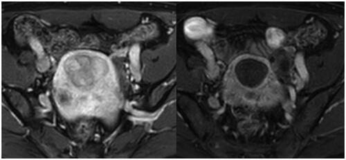 Figure 2. Axial MRI of fibroid at baseline (36.1 × 47.4 mm) and at 6 months post treatment (33 × 35.8 mm).