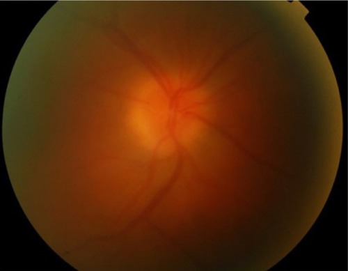 Figure 1 Sarcoid-related panuveitis with vitreous haze and right-eye optic disk swelling.