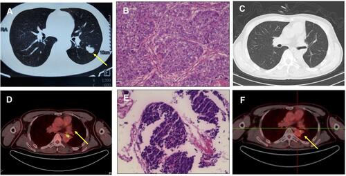 Figure 1 (A) Preoperative chest CT scan (captured on March 19th, 2018). (B) Histology revealed squamous carcinoma of the lung (x100). (C) Postoperative chest CT follow-up (captured on April 11th, 2018). (D) PET-CT scan (captured on July 18th, 2019). (E) Histology findings indicated SCLC. (F) PET-CT scan (captured on September 11th, 2019). Significant abnormal findings were noted (arrow).