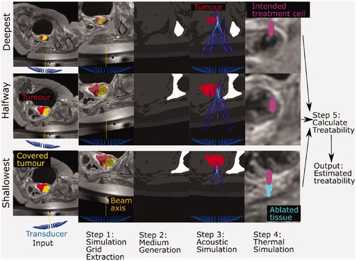 Figure 1. Schematic for the methodology used to estimate patient treatability. Inputs include the anatomical patient MR images (representative slices shown here), the three exposure points (magenta), the tumor segment (red), and the covered (i.e., device reachable) tumor volume (yellow overlaid on the tumor segment). The transducer (blue) is positioned and angled such that the geometric focus was placed at reachable exposure points. In step 1, simulation grids are extracted from the larger MR image datasets. In step 2, each grid voxel is assigned acoustic and thermal properties using thresholds. A density image is displayed, with white denoting the densest material (bone) and black denoting the least dense material (oil) in the image. In step 3, an acoustic simulation is performed in order to estimate the acoustic pressure field within the complex distribution of tissues. The pressure field, overlaid on the density map and segmented tumor, shows regions of high (yellow) and low (blue) pressure. In step 4, thermal simulation identifies where tissue ablation should result from acoustic energy absorption and heat transfer. The thermal dose delivered to tissue is calculated. In Step 5, the patient treatability is estimated by examining the positions and volumes of ablated tissues (cyan) for the three exposure points in order to identify the maximum treatable depth, and hence, the treatable tumor volume (output).