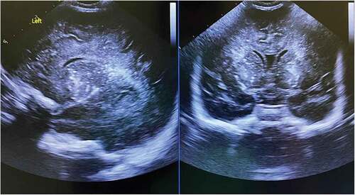 Figure 1. Head ultrasonography suggested thalamic and peri-ventricular calcifications