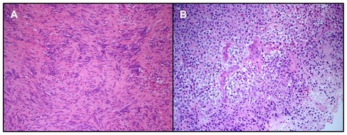 Figure 3 Loosely textured neoplasm made of spindle cells without significant cytological atypia seen on hematoxylin and eosin staining. Mitotic figures were not seen. The lesion was intensively stained by S100 protein (not shown). This image was taken from a small area of the tumor where the nuclei were aligned, suggesting initial formation of Verocay bodies. No true Verocay bodies were found since the lesion had mostly regressive areas. The morphology is consistent with a diagnosis of schwannoma (A). Hematoxylin and eosin staining showing an oligodendroglioma made of monomorphic cells with rounded nuclei and clear perinuclear halos. This image shows a small area of necrosis and newly formed blood vessels, consistent with early anaplastic transformation in the oligodendroglioma (B).