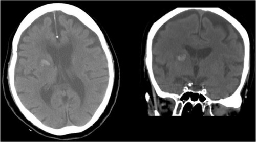 Figure 1 Brain computed tomography scans showing acute hemorrhage at the right putamen.