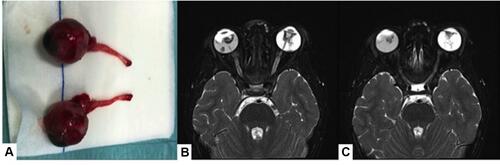 Figure 1 Bilateral RB cT4b treated with bilateral enucleation with a pre-chiasmatic approach with collaboration with neurosurgery. Macroscopic image of the two enucleated ocular globes (A). Magnetic resonance imaging before surgery (B and C).