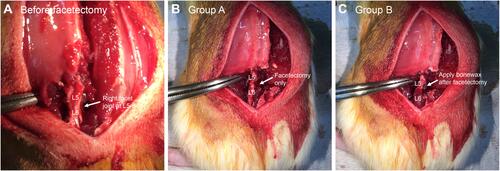 Figure 2 Facetectomy of the right L5-6 facet joint. (A) Normal facet on right L5-6. (B) In group A, subcutaneous tissue and skin were closed immediately after right facetectomy, and the surgery was completed. (C) In group B, bone wax was applied to the facetectomy site, the subcutaneous tissue and skin were closed, and the surgery was completed. The images are those of Sample #2 from Group A and Sample #1 from Group B.