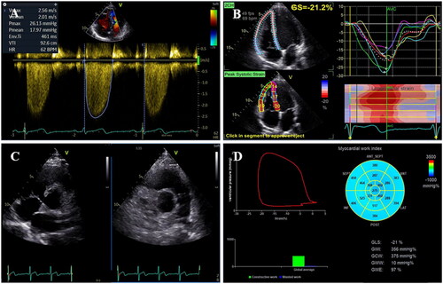 Figure 2. Tracing the tricuspid regurgitation velocity-time integral; (B) Analysis of speckle tracking echocardiography-derived right ventricular global longitudinal strain; (C) Evaluation of the event timings of the tricuspid valve and pulmonic valve in the parasternal short-axis views; (D) Measurement of right ventricular myocardial work by incorporating pulmonary pressures, right ventricular strain, and cardiac cycle timings [Citation23].