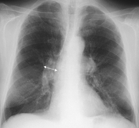 Figure 1 Moderate functional obstruction on respiratory function tests of a 70-year-old patient. X-ray picture of emphysema with pulmonary hyperinflation and thinning of the vascular pattern (arterial deficiency) with hypertension of the small circulation documented by the dilatation of the descending branch of the right pulmonary artery (arrow).