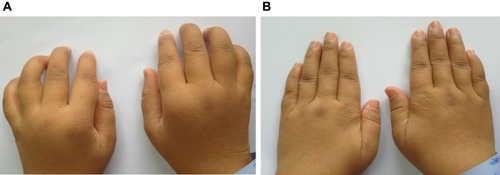 Figure 7 A 33-year female, with 4 years of illness, (A) difficulty in clenching, swelling and pain, morning stiffness, (B) After UC-MSC cells treatment 1 week, the symptoms improved significantly.