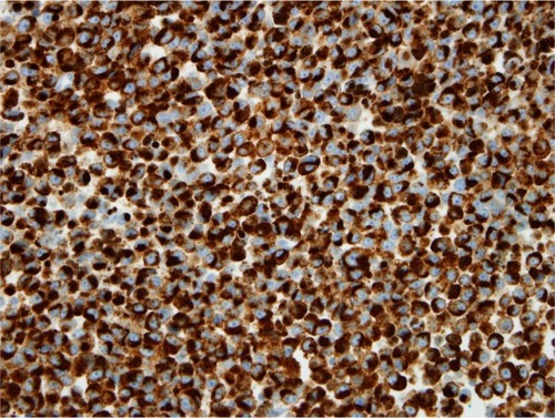 Figure 4 Brown marking of intracytoplasmic tumor cells with HMB45 and melan A in immunohistochemistry on paraffin section (magnification ×40).