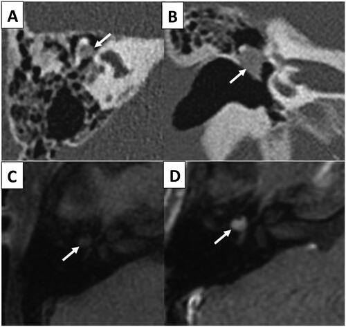 Figure 2. Axial (A) and coronal (B) images from the unenhanced temporal bone CT. The white arrows indicate the abnormal incus that was enlarged and demonstrated a relative abnormal lucency when compared to the rest of the malleus and body/short process of the incus. Axial T1 pre contrast (C) and axial T1 post contrast (D) images from an MR IAM. The white arrows demonstrate the abnormal expansile lesion centred on the incus with evidence of contrast enhancement.