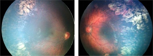 Figure 1 A male infant who was born at 29 weeks’ gestation and of birth weight 1.450 g. OU: ROP stage 2 and 3, zone 1, with plus disease. ROP regressed bilaterally after laser treatment. Refraction at 65 months of age: OD, −7.25 D/−3.50 D, axis 11 degrees; OS, −6.50 D/−2.75, D axis 170 degrees.