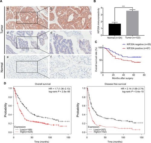 Figure 3 Survival analysis of patients with GC based on KIF20A expression.Notes: (A) Representative images of KIF20A in GC tissues and adjacent normal tissues: (a, b) high KIF20A level in cancerous epithelia; (c, d) low KIF20A level in cancerous epithelia; (e, f) low KIF20A level in normal gastric epithelia. Magnification: (a, c, e) 100× and (b, d, f) 200×. (B) Comparison of KIF20A immunoreactivity of GC tissues (n=122) and normal gastric tissues (n=24) in the TMA. The immunoreactivity is presented as mean±SEM. ***P < 0.001. (C) The overall survival analysis based on KIF20A expression in the TMA. (D) The prognostic value of KIF20A level in GC patients from Kaplan–Meier plotter database.Citation26Abbreviations: GC, gastric cancer; SEM, standard error of the mean; TMA, tissue microarray.