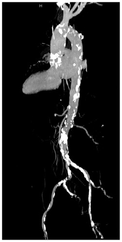 Figure 1 Computed tomography of the severely calcified aorta.