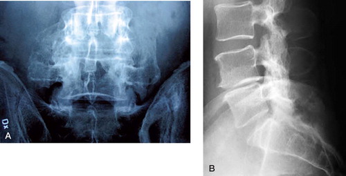 Figure 4:1 Uninstrumented fusion with solid bony bridging between the transverse processes of the L4 and L5 vertebra. A. Anteroposterior view. B. Lateral view.