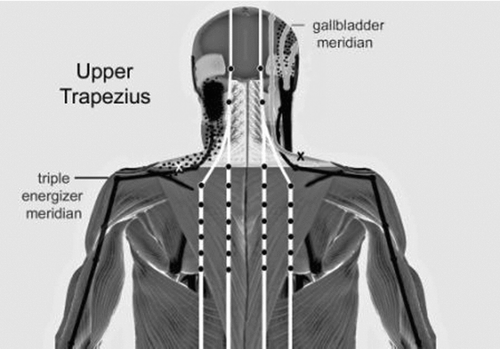 FIGURE 1 Differing myofascial referred pain patterns of the upper trapezius muscle and anatomically proximate trigger points.