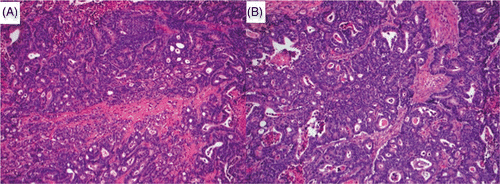 Figure 7. Untreated (A) and ablated (B) colorectal liver metastasis ×20 (H&E stain). Cells have large nuclei and disorganised glandular structure, appearances consistent with viable well differentiated adenocarcinoma. Further investigation using enzyme histochemistry and transmission electron microscopy confirmed that despite well preserved cellular anatomy this tumour was not viable.