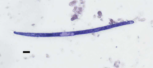 Figure 3.  (Colour online) Impression of thawed lung from an emaciated boreal owl showing a sheathed, round-tailed, round-headed microfilaria. Scale bar = 10 µm; modified Wright–Giemsa stain (Dip Quick; Jorgensen Labs. Inc., Loveland, Colorado, USA).