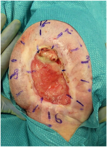 Figure 3. Field biopsy with the extraction of 12 cutaneous tissue samples from the wound margin.