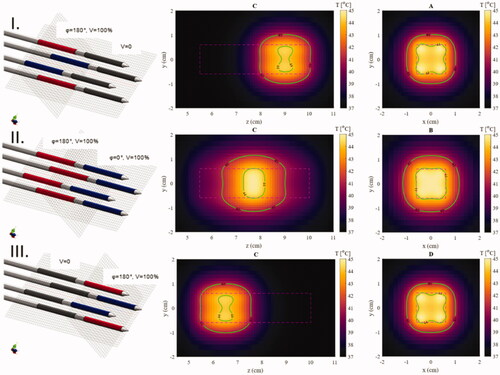 Figure 10. Temperature maps after 5 min of heating in an agar phantom for different phase configurations showing the ability to define a specific region along the catheter that is heated. Isotemperature contours (green lines) of 41 and 44 °C are visible on all images. Left: The phase and power configuration of the electrodes (dark gray: no power, blue: phase is 0, red: phase is 180°). Center: The central longitudinal plane parallel to the applicators showing the control of the longitudinal position of the focused area (cross-section C in Figure 3). Right: The central plane of the focused area perpendicular to the applicators (cross-sections A, B, or D in Figure 3).