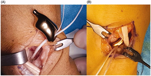 Figure 3. (A,B) The titanium implant was positioned. Arthrex™ labral tape was fixed into the lunate and passed through the implant. The distal stem of the implant was set into the hole prepared into the trapezium.