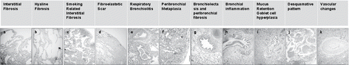 Figure 2. Illustrative examples of cancer lobectomy sections showing pre-specified histologic patterns as indicated, including various subtypes of fibrosis patterns. See also Table 3.