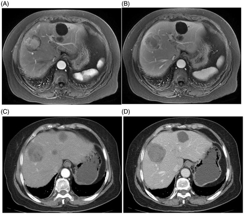 Figure 2. Imaging document of the presence and disappearance of HCC lesions. The MWA-treated subject was a 52-year-old male HCC patient who had HBV-related liver cirrhosis. (A) Arterial phase; (B) Portalvenous phase. Pre-treatment CT images shows a tumour as a 5.4-cm hyperintense nodule on an intense arterial enhancement (A), with an enhancement recession (B). (C) Arterial and (D) portalvenous phase. MRI images obtained at four weeks after treatment show no enhancements inside or beside the ablation zone.