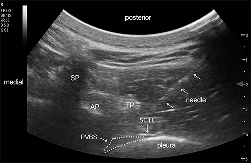 Figure 1 Ultrasound image of in-plane needle advancement into the thoracic paravertebral space at the eleventh thoracic vertebral level.