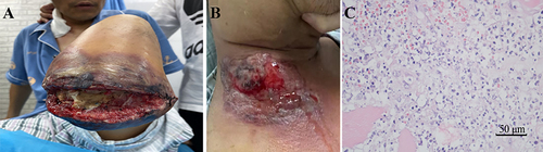 Figure 2 Amputation, pathergy and histopathologic examination. (A) Post-operative amputation showed a greenish-purple necrosis and punctate ulcers around the wound; (B) Ulcers at the cannulation site of right internal jugular vein. (C) Hematoxylin & Eosin stain showing numerous neutrophil infiltrates with skeletal muscle degeneration.