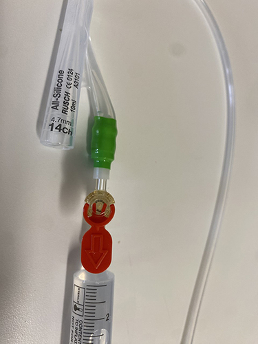 Figure 2 Transurethral catheter safety valve is attached to the balloon inflation channel of a Foley catheter. A 10 mL syringe filled with sterile water is connected to the safety valve.