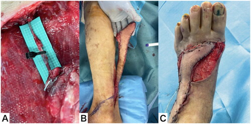 Figure 8. Clinical course throughout the 12 d after flap elevation. (A) The superficial sural vein was thrombosed distal to the vascular clip. (B) The superficial sural vein was dissected and the flap transferred. (C) The color of the flap remained normal after surgery.