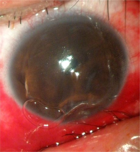 Figure 2 After reposition of the corneal flap a bandage soft contact lens is placed on the cornea for protection under surgical microscope. without epithelial ingrowth.