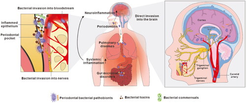 Figure 2. Current proposals on how oral bacteria may promote the progression of Alzheimer’s disease. Oral bacteria have been proposed to promote AD pathology by two mechanisms. Firstly, oral bacteria may impact the central nervous system indirectly by causing periodontitis, by aggravating pulmonary diseases after aspiration to the respiratory system and by provoking microbiota-gut-brain axis disorders in the alimentary tract (Wu et al. Citation2017; Xue et al. Citation2020). This induces chronic systemic inflammation which subsequently extends to the brain adding to the load of neuroinflammation. Secondly, discontinuous sites within inflamed periodontal pocket epithelia allow periodontal bacteria to invade adjacent primary afferent nerves and blood vessels, along which they escape the oral cavity and directly access the brain, leading to brain infection.