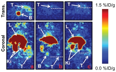 Figure 7 PET images of 3 representative subcutaneous LS174T tumored mice that received an IV injection of A) SWCNT-([89Zr]DFO)(E4G10); B) low SA 89Zr-DFOSWCNT- E4G10 (competitive inhibition or blocking control experiment); and C) nonspecific control construct SWCNT-([89Zr]DFO)(anti-KLH) recorded at 24 hours after injection. The top panel is the transverse image and the bottom panel is the coronal image. The notations T, L, Ki, and B indicate the tumor, liver, kidneys, and bladder, respectively.Abbreviations: PET, positron emission tomography; IV, intravenous; SWCNT, single wall carbon nanotube; 89Zr, zirconium-89; DFO, desferrioxamine B; SA, specific activity; anti-KLH, anti-keyhole limpet hemocyanin; Trans, transverse.