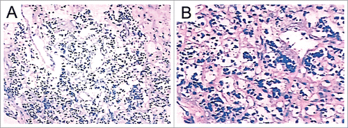 Figure 3. Post-operative histological examination showing small cell malignant tumor and highly suspicious of malignant peripheral primitive neuroectodermal tumor with CD99 and NSE intense positive identification. Magnification, A: x100, B: x200.