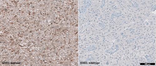 Figure 2 IDH1 mutation status in glioblastoma using immunohistochemistry (IHC). IDH1 mutation showed positive expression while IDH1-wildtype showed negative expression). Scale bar, 100 μm.