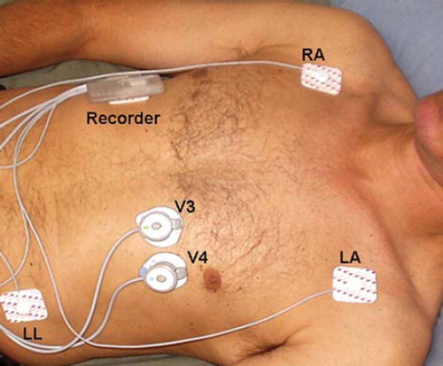 Figure 1. Ambulatory acoustic cardiography monitor. Placement of the recorder unit and the ECG/sound sensors. Regular ECG monitoring electrodes are placed on the right arm, left arm, and left leg locations for ECG monitoring. Combined ECG/sound sensors are placed in the precordial V3 and V4 positions. The recorder unit is either placed on the patient's chest or abdomen.