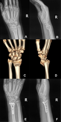 Figure 2 Preoperative X-ray films (A and B) and three-dimensional reconstructive CT images (C and D) of right wrist. Postoperative X-ray films of right wrist (E and F).