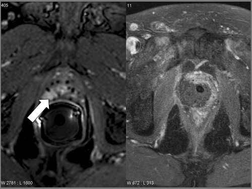 Figure 4. Focal HIFU after brachytherapy failure. The MRI on the left shows an enhancing tumour at the left peripheral zone extending to the right and crossing the midline. On the right, the post-operative MRI shows the destroyed area with no residual enhancement.