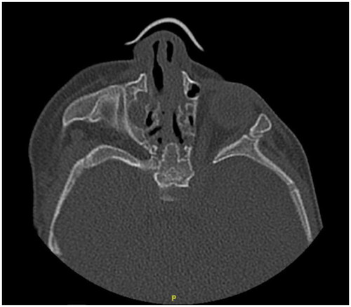 Figure 2. CT PNS axial cut of patient 2: showing left side deviated nasal septum with minimal adhesions on right side.