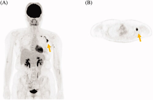 Figure 1. (A) 3 D MIP 18F-FDG PET image in coronal view shows increased uptake in the left axillary lymph nodes (SUVmax, 12.7). In the left deltoid muscle, no increase in FDG uptake was observed. (B) Axial view shows the same finding as the 3 D MIP image.