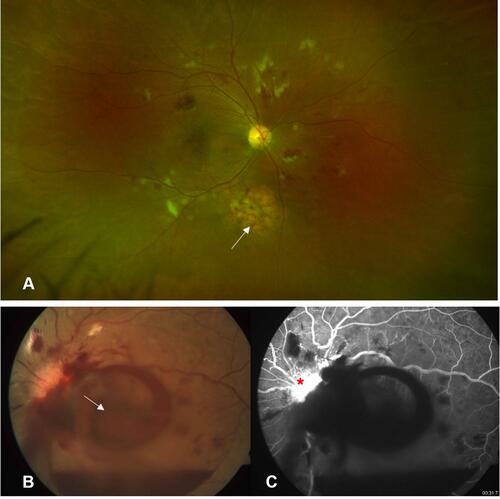 Figure 1 (A) Non-proliferative stage of radiation retinopathy following external beam radiation therapy for adenocarcinoma of lung with brain metastasis. White arrow points towards area of choroidal metastasis. Fundus photo (B) of a patient with proliferative stage of radiation retinopathy after radiotherapy for cerebellar metastasis, showing preretinal hemorrhage (white arrow) over macula, while fundus fluorescein angiography (C) confirmed the presence of a leaking neovascularization of disc (red asterisk).